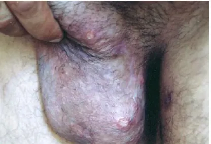 Fig.4 : Genital ulcers in a male patient 