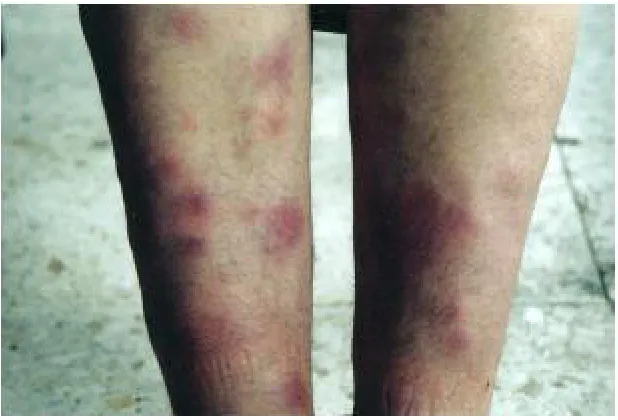 Fig. 6 : Erythema – Nodosum like lesions on the lower extremeties 