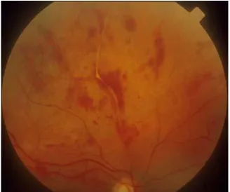 Fig. 9 : Retinal Vasculitis seen in Behçet’s disease 