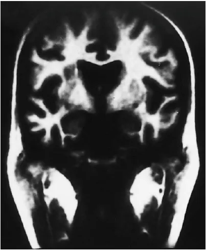 Fig.10 :Grey – matter lesions showing involvement of the Central Nervous 