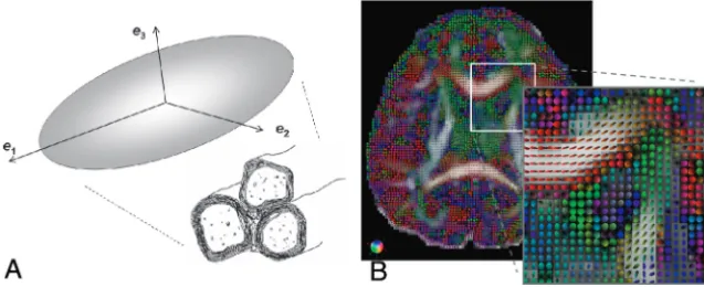 Fig 2. A, Schematic drawing showing the relationship be-tween the diffusion tensor ellipsoid and the underlying whitematter fiber bundle
