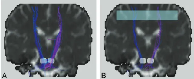 Fig 4. Bilateral corticospinal tracts of a healthy subject withbe removed by selecting one more region of interest (thetranslucent box inpass through this region