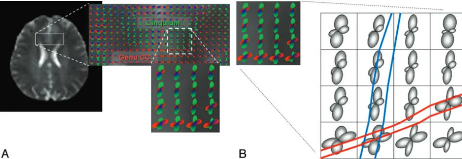 Fig 5. A, Fiber crossing within 1 image voxel can be resolved by using HARDI, where the directions of the multiple fiber bundles are depicted by orientation distribution functions magnifiedin the lower right corner