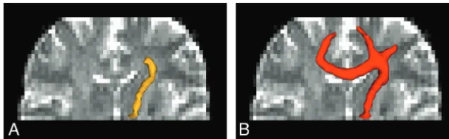 Fig 6. Tractography results obtained from a healthy subject, showing tracts possibly associated with the seed point placed at the lower level of the internal capsule with connectionindicating that users have to be cautious when selecting the probability th