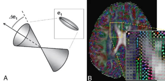 Fig 7. Aof a diffusion tensor ellipsoid in an image voxel (upper right) is now replaced by a double cone (lower left), whose angular width represents the data-fitting uncertainty.of the double-cone map showing the fiber direction and its uncertainty simult