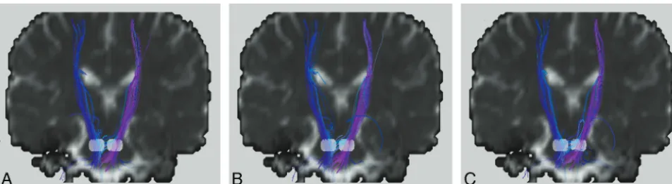 Fig 8. A somewhat exaggerated comparison of the signal–to-noise ratio effects on diffusion MR tractography