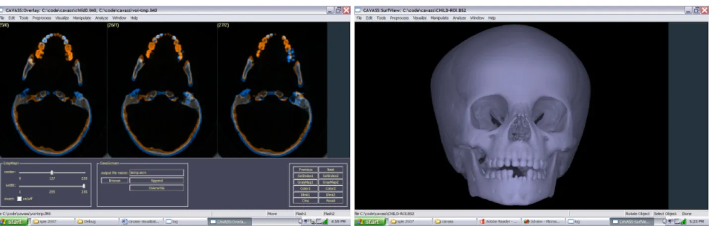 Fig. 2.  Examples of overlaid slice display (left) and triangulated shell (t-shell) rendering (right) in CAVASS on the Windows  operating system