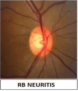 Figure 3-Showing disc changes in optic neuritis 
