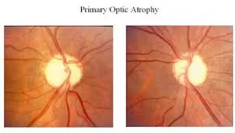 Figure 4-Shows pale disc in optic atrophy 