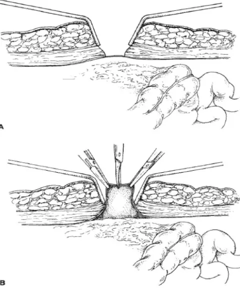 Fig 21 : Open Technique For Pneumoperitoneum Creation 