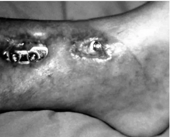 Fig. 25: Wound dehiscence after ORIF. 