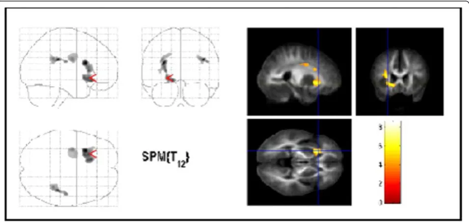 Table 2 MTR-, ADC- and FA-map differences in patients with OCD compared to healthy control subjects