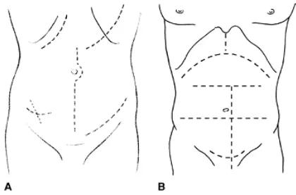 FIG: 9A Different types of incision 