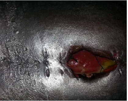 Fig: 3 COMPLETE WOUND DEHISCENCE EXPOSING BOWEL 