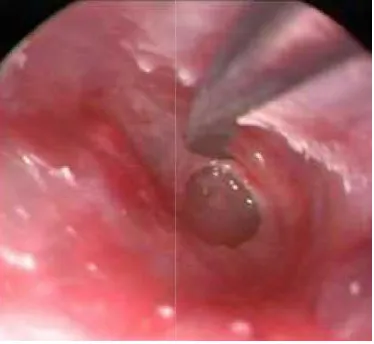 Fig-5; Shows central perforation of the tympanic membrane (RT Ear) 