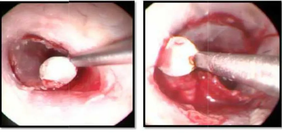 Fig-7; Canal incision and elevation of tympanomeatal flap 