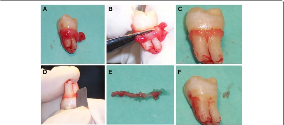 Figure 2 JE samples. A. Remove fully erupted impacted tooth with marginal gingival; B