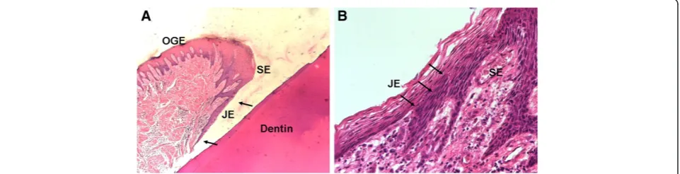 Figure 3 HE staining of human gingival tissue. A. The region between the arrows is JE (x150); B
