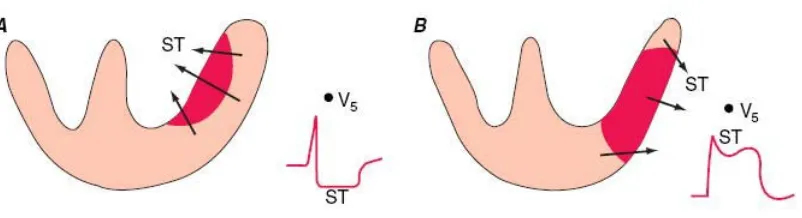 Fig 6: SUBENDOCARDIAL AND TRANSMURAL INFARCT: 