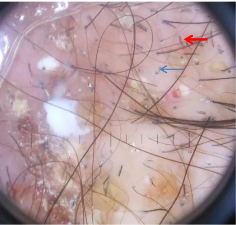 FIGURE 18: HIGH POWER VIEW OF SCALP SCRAPINGS IN 10%KOH SOLUTION