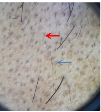 FIGURE 20: DERMOSCOPIC FINDINGS IN ANDROGENETICALOPECIA