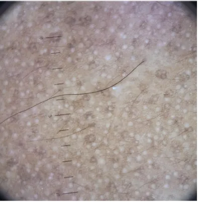 FIGURE 20: DERMOSCOPIC FINDINGS IN ANDROGENETICALOPECIA