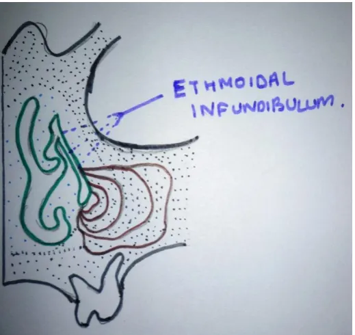 Figure 1:Development  of  maxillary  sinus  from  ethmoidal  infundibulum. 