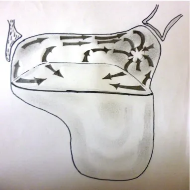Figure 4 A half  filled  maxillary  sinus.  The  cohesional  forces  of  the  