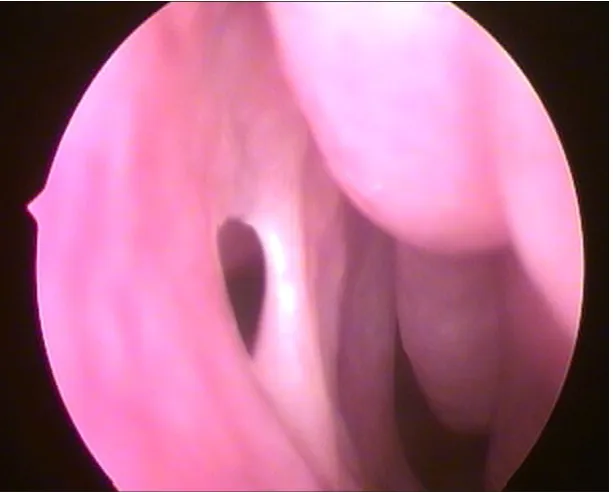 Figure 8a  Right  sided AO  in  a  patient  with  CRS 