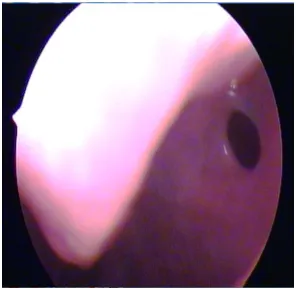 Figure 9 A  closer  look  at  the  same  AO  showing  the  interior  of  maxillary  sinus 