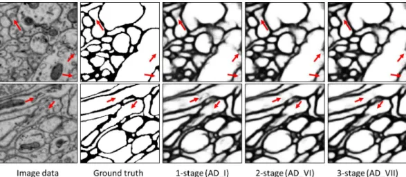 Figure 3. Qualitative comparison between 1-stage (AD I), 2-stage (AD VI) and 3-stage (AD VII) networks