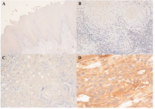 Figure 4. Immunohistochemistry. A, Normal oral mucosa displayed absent or very weak cytoplasmic NNMT immunoreactivity in all ep-ithelial layers