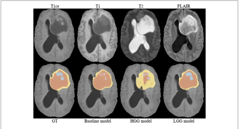 FIGURE 10 | Brats18_TCIA05_444_1.