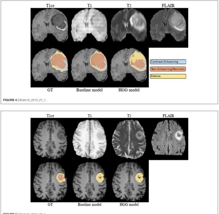 FIGURE 5 | Brats18_2013_25_1.