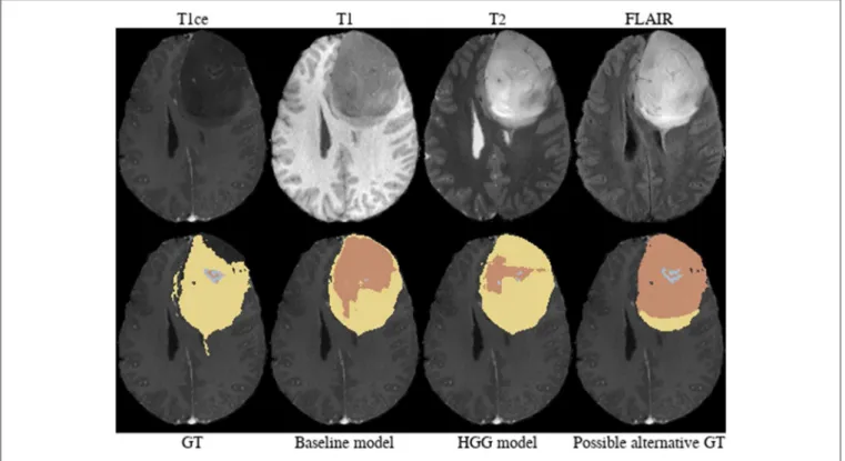 FIGURE 6 | Brats18_CBICA_AXJ_1.