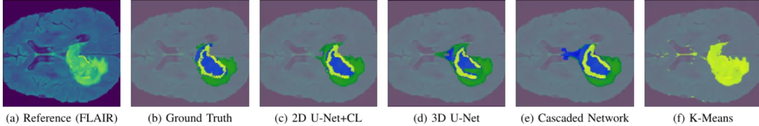 Fig. 1: Brain tumor segmentation of an MRI slice using different methods. The different sub-regions correspond to whole tumor region (green+yellow+blue), tumor core region (yellow+blue) and enhancing tumor region (blue).