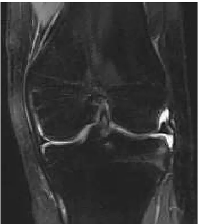Figure 7: MRI showing normal ACL in sagittal plane 