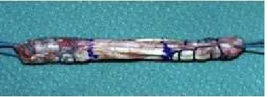 Figure 14: Quadrupled Hamstring Graft 