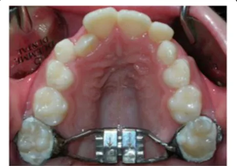 Fig. 1 Hyrax-type expander anchored to permanent teeth
