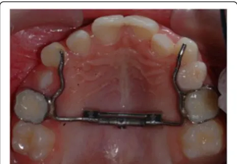 Fig. 2 Modified Hyrax-type expander anchored to deciduous teeth