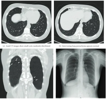 Figure 2: Preoperative CT scan of the thorax (a–c) and chest X-ray (d).