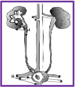 Fig 1: Stones in kidney (i) ureter and (ii) bladder