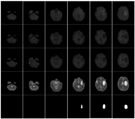 Figure 1 shows examples of BRATS data with ground truth seg- seg-mentation.