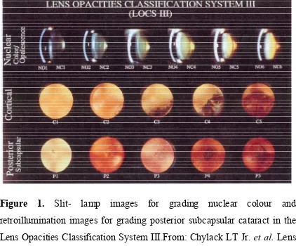 Figure 1. Slit- lamp images for grading nuclear colour and 