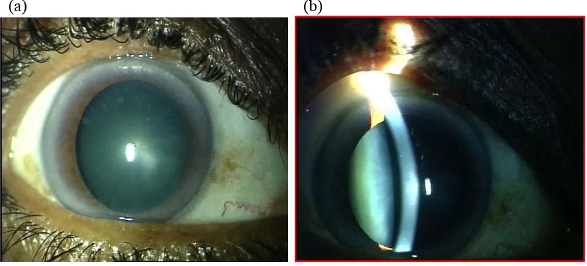 Figure 3.  Anterior segment photographs of the right eye showing Grade 2 
