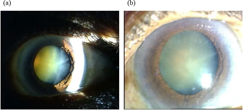 Figure 5.  Anterior segment photographs of the right eye showing Grade 4 