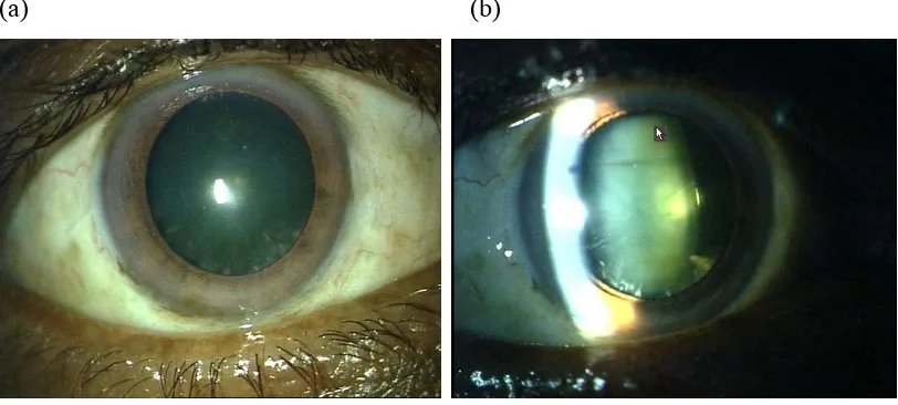 Figure 7.  Anterior segment photographs of the right eye showing posterior 