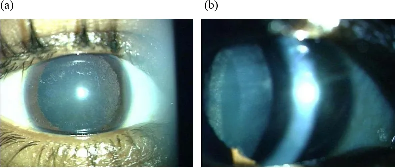 Figure 8.  Anterior segment photographs of the right eye showing posterior 