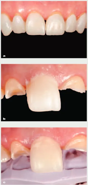 Fig 8 The restorations are tried on. Any gaps will be filled during the adhesive cementation (a)