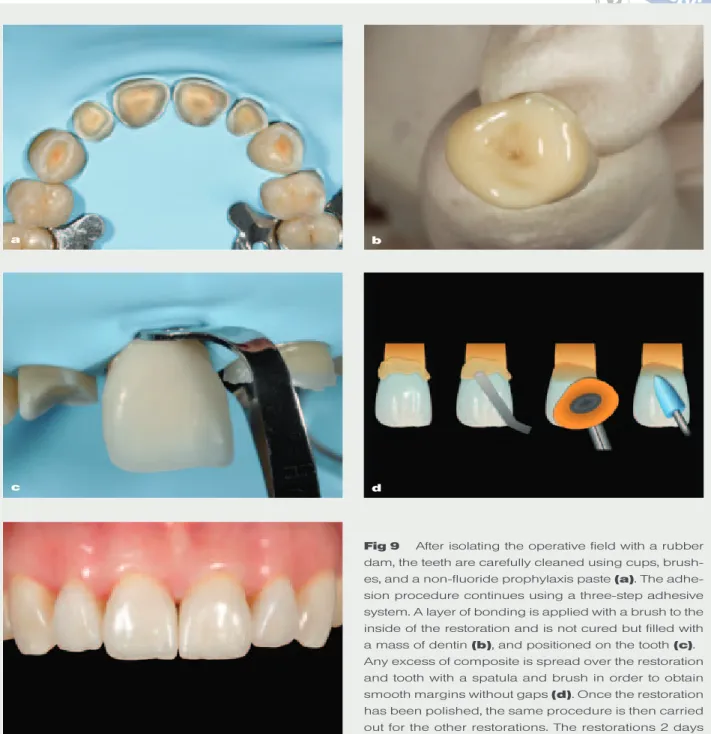 Fig 9 After isolating the operative field with a rubber dam, the teeth are carefully cleaned using cups,  brush-es, and a non-fluoride prophylaxis paste (a)